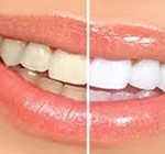 Teeth whitening