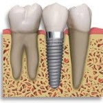 Dental Implants London Dental Plan